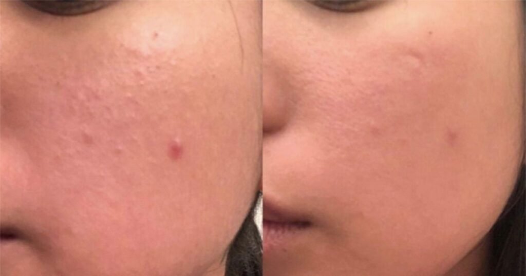 This Pain-Free Derma Roller Is Producing the Most Incredible Before and After Photos