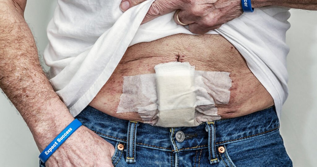 Why does colon cancer grow so fast? Study points to new ways to lower your risk