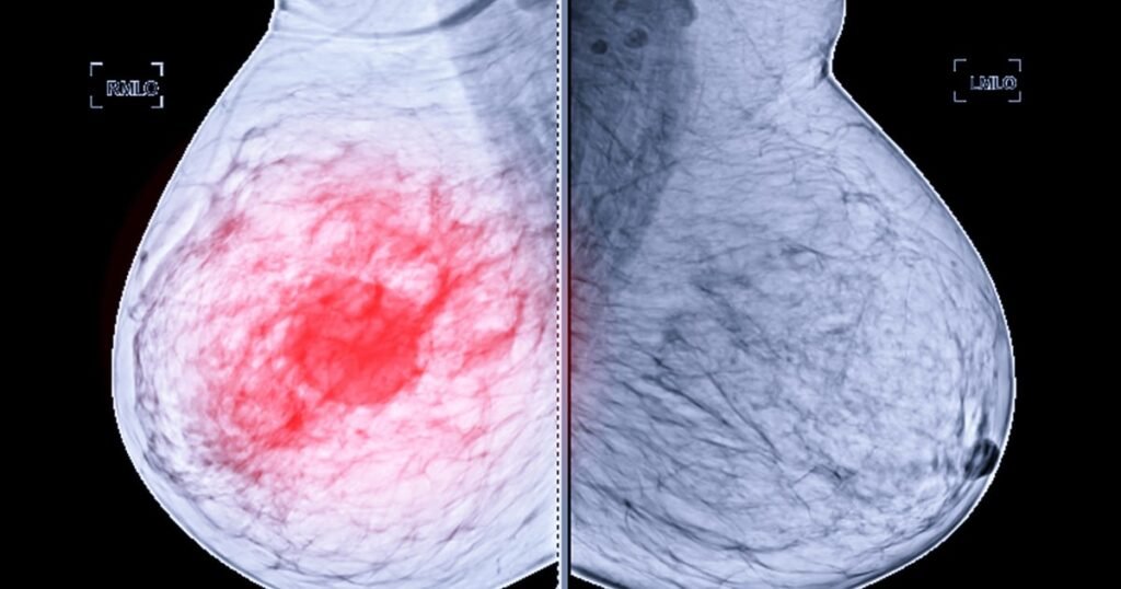 What is a lumpectomy? Katie Couric’s breast cancer surgery explained