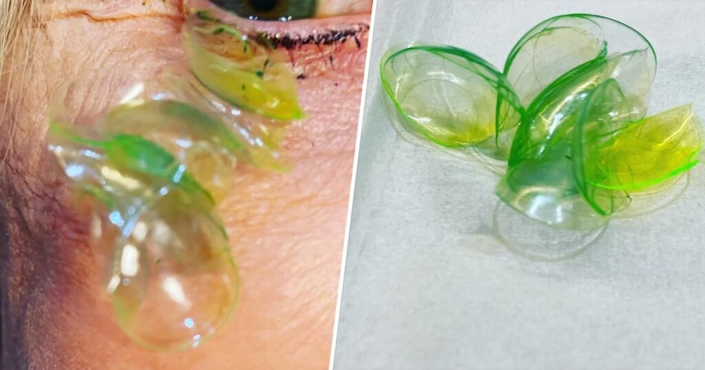 Woman Had 23 Contact Lenses Stuck Under Her Eyelid, Doctor Says