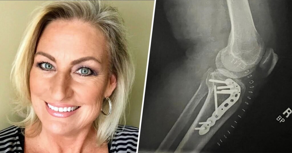 Woman breaks leg after falling into unfilled hole at the beach, warns others