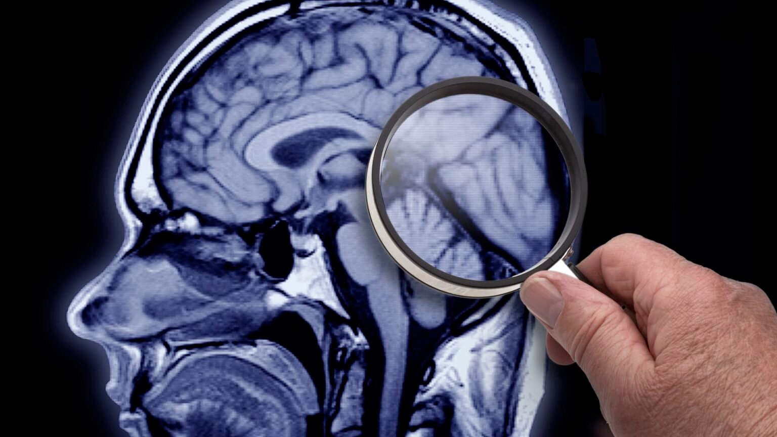 FDA approves Alzheimer’s drug that slowed cognitive decline in clinical trial