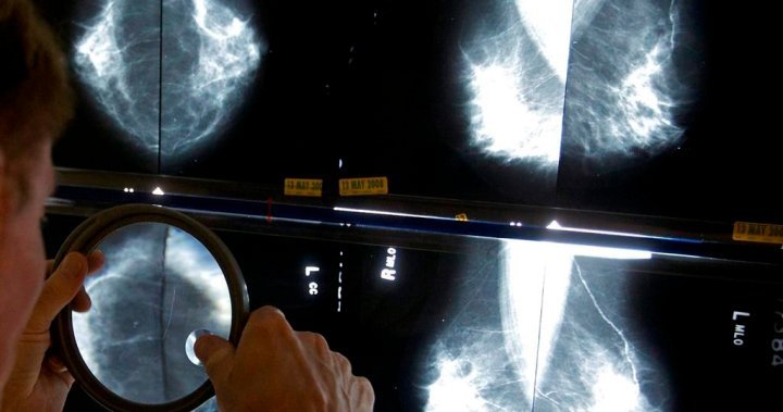 Cancer survival rates higher when detected at earlier stages: StatCan study