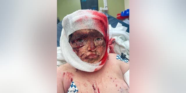 Justin Gilstrap, 11, was pulled from his bicycle and attacked by three pit bulls — suffering multiple injuries. He is still in the hospital three weeks later.