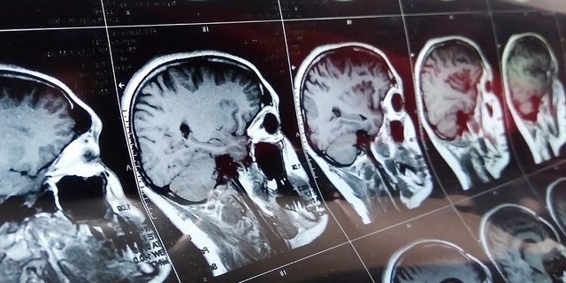 A new study has found that mortality rates among those with moderate to severe head injuries were almost three (2.87) times higher than for those who had not experienced head injuries.