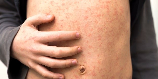 The 82 measles cases in Franklin County, Ohio, make up the bulk of the nation's 117 reported cases.