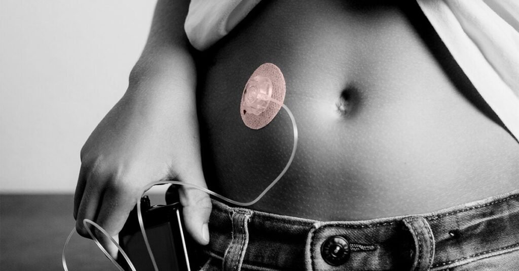 Type 2 diabetes: Artificial pancreas may soon be an option